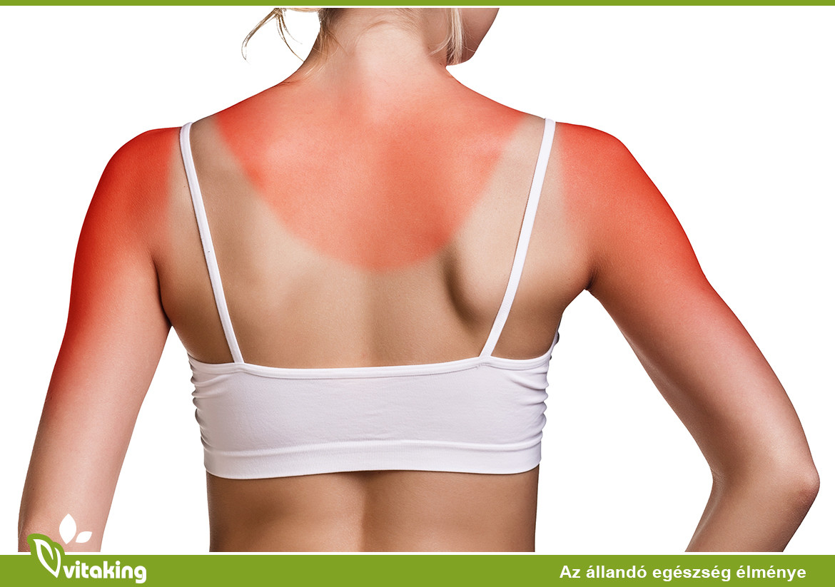 8+1 otthoni gyógymód a leégés orvoslására